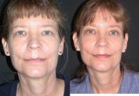 Endoscopic forehead lift, Upper and Lower Blepharoplasty