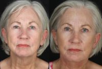 65-74 year old female, Facelift, Necklift, Earlobe Reduction, Upper & Lower Eyelid Surgery, Browpexy, & Facial Fat Grafting
