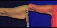 45-54 year old woman treated for Arm Lift