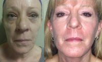 65-74 year old woman treated with Face and neck lift and fractional CO2 laser