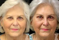 65-74 year old woman treated with Brow Lift and Upper Eyelid Surgery