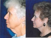 Lower face lift and chin implant