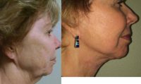 65-74 year old woman treated with Facelift, neck lift and CO2 laser resurfacing