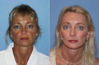 Dr Mark Prysi performed a Endoscopic Composite Facelift , Endoscopic Browlift upper lid surgery and Laser to eyes and mouth