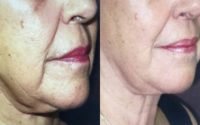 65-74 year old woman treated with Ultherapy