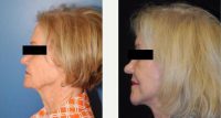 Dr Ned Snyder, IV, MD, Austin Plastic Surgeon - 69 Year Old Woman Treated With MACS Facelift