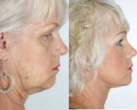 65 year old woman treated with Facelift
