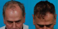 55 year old man treated with Hair Transplant