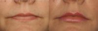 41 year old woman treated with Restylane