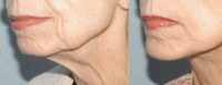 74 year old woman treated with Chin Implant