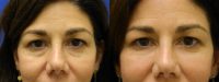 45-54 year old woman treated with Dark Circles Under Eye Treatment