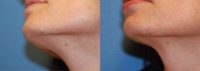 Skin lesion mole removal