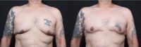 This 50 year old male underwent extended chest reduction