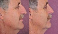 Man treated with Nose Surgery