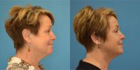 55-64 year old woman treated with PrecisionTx
