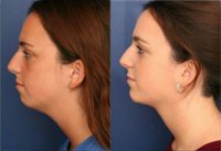 Woman treated with Cervicoplasty and Chin Implant