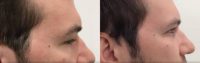 Man treated with Brow Lift