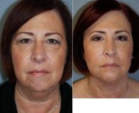 Dr Russel S. Palmer, MD, Fort Lauderdale Plastic Surgeon - 66 Year Old Woman Treated With Facelift