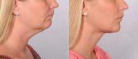 Neck lift for a young woman
