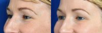 35-44 year old New Orleans woman treated with Botox