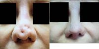 55-64 year old woman treated with Revision Rhinoplasty