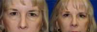 55-64 year old woman with lower blepharoplasty