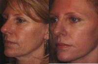Female Facelift and Laser Resurfacing