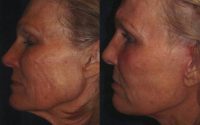 Female Treated for Skin Laxity and Aging