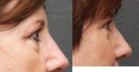55-64 year old woman treated with Lower Eyelid Surgery