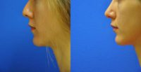 rhinoplasty - for appearance and breathing