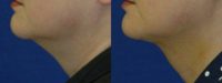 Submental liposuction (Liposuction under the chin)