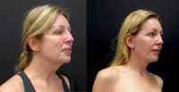 56 year old woman treated with Facelift