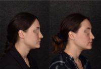 25-34 year old woman treated with Chin Liposuction
