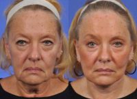 65-74 year old woman treated with Cheek Lift