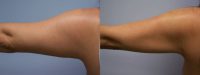 Liposuction of arms