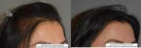 Forehead Reduction/Hairline Lowering with Hair transplantation