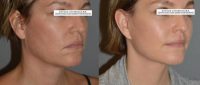 Facelift, Necklift, Upper and Lower Blepharoplasty, Endoscopic Browlift