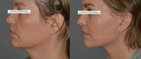 Facelift, Necklift, Upper and Lower Blepharoplasty, Endoscopic Browlift