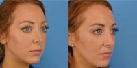 25-34 year old woman treated with Cheek Filler