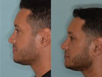 25-34 year old man treated with Revision Rhinoplasty