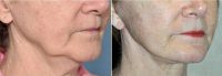 Dr. Barry L. Eppley, MD, DMD, Indianapolis Plastic Surgeon - 64 Year Old Woman Treated With Facelift