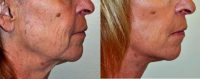 Dr. Barry L. Eppley, MD, DMD, Indianapolis Plastic Surgeon - Facelift