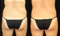 40 year old woman treated with CoolSculpting Non Surgical Fat Reduction