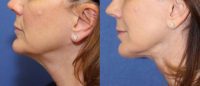 68 year old woman with an open Neck Lift