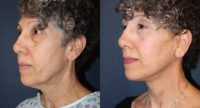 55-64 year old woman treated with Facelift, Neck Lift and Neck Liposuction