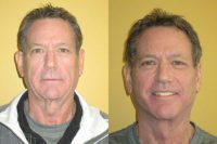 60 yo Lost 25 lbs and Felt Like His Face Looked Old Now.