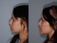 Rhinoplasty for dorsal hump removal