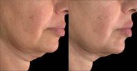 Woman treated with Ultherapy