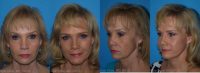 Lower face & neck lift with perioral dermabrasion