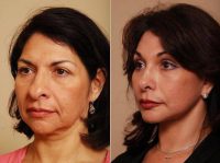 Dr. Christian G. Drehsen, MD, Tampa Plastic Surgeon - RefresherLift W BrowLift, Rhinoplasty And Fat Micrografting